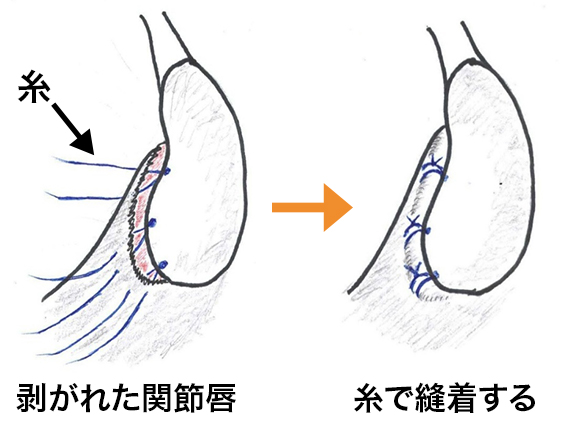 肩関節脱臼（反復性脱臼）1